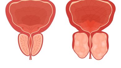 REZUM ou HoLEP Qual a melhor cirurgia para a hiperplasia prostática benigna (HPB)