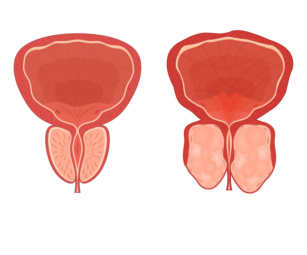 REZUM ou HoLEP Qual a melhor cirurgia para a hiperplasia prostática benigna (HPB)