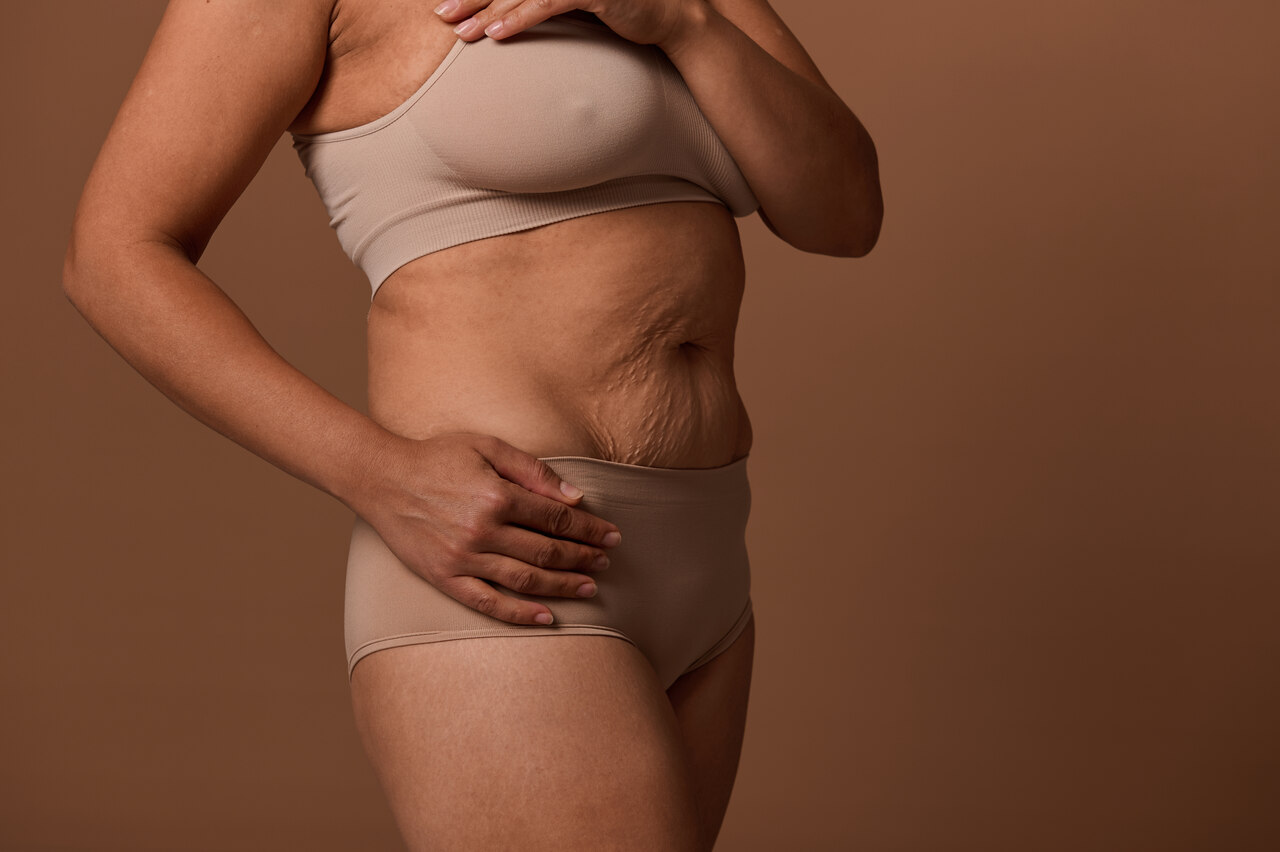 Abdominoplastia: cicatriz pequena, transformação gigante