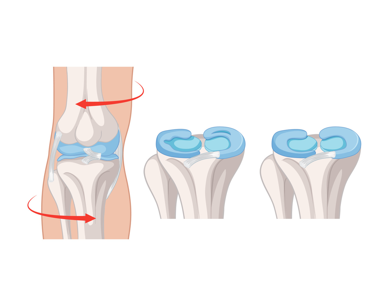Dor, estalos e travamento no joelho Pode ser lesão no menisco