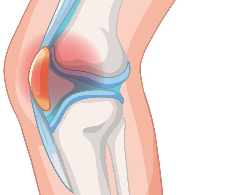 Dor na frente do joelho Pode ser condropatia patelar