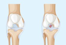 Lesão do LCA o problema que pode estar no seu joelho sem você saber